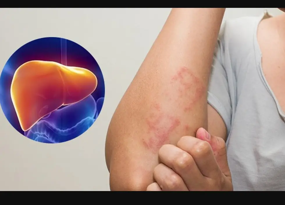 Cẩn thận: Ngứa 2 chỗ này trên cơ thể là biểu hiện của bệnh gan, đừng nhầm với dị ứng