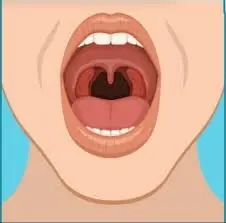 Thực phẩm có thể gây UT vòm họng 'nhanh khủng khiếp', thèm đến mấy cũng nên hạn chế ăn