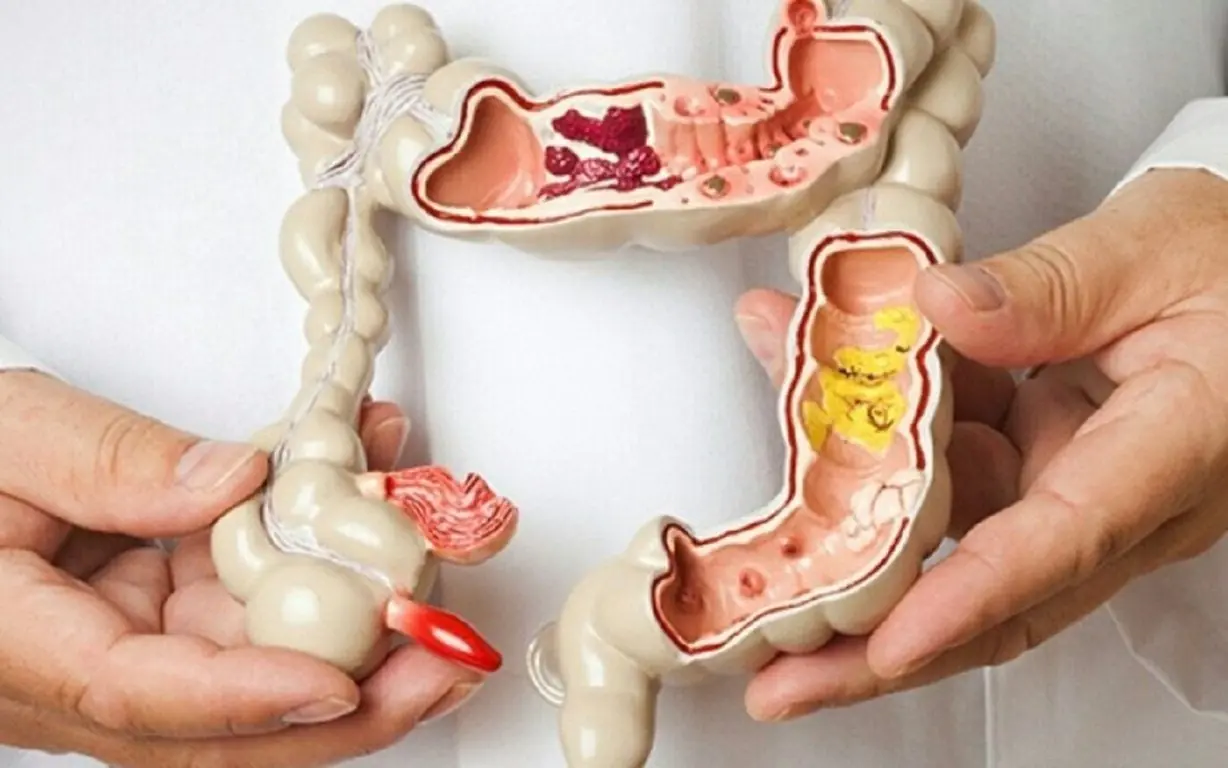 Nếu có polyp trong ruộtt, khi đi vệ sinh sẽ có 4 dấu hiệu này, đi khám ngay kẻo muộn