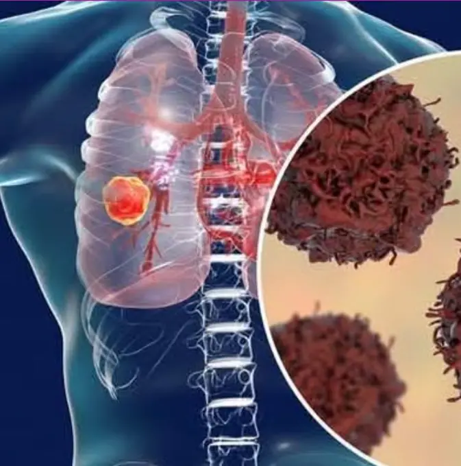 Nếu bị đau 3 chỗ này có thể bạn đã mắc 'UT phổi' - Phát hiện sớm mới mong kéo dài sự sống, đừng để 'hối không kịp'