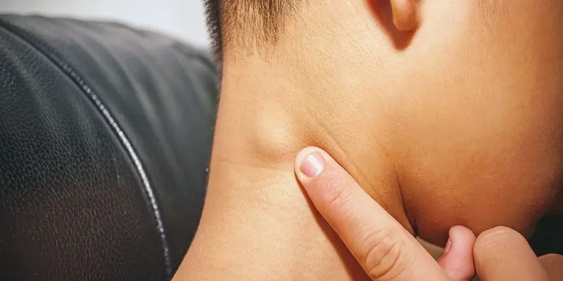 Người sắp bị UT thường có 3 dấu hiệu lạ ở cổ, có dù chỉ 1 bạn cũng cần đi khám khẩn cấp