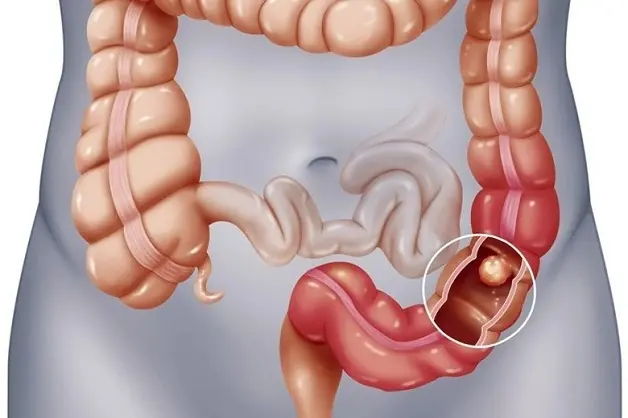 Nếu có polyp trong ruột, khi đi vệ sinh sẽ có 4 dấu hiệu này, đi khám ngay kẻo muộn
