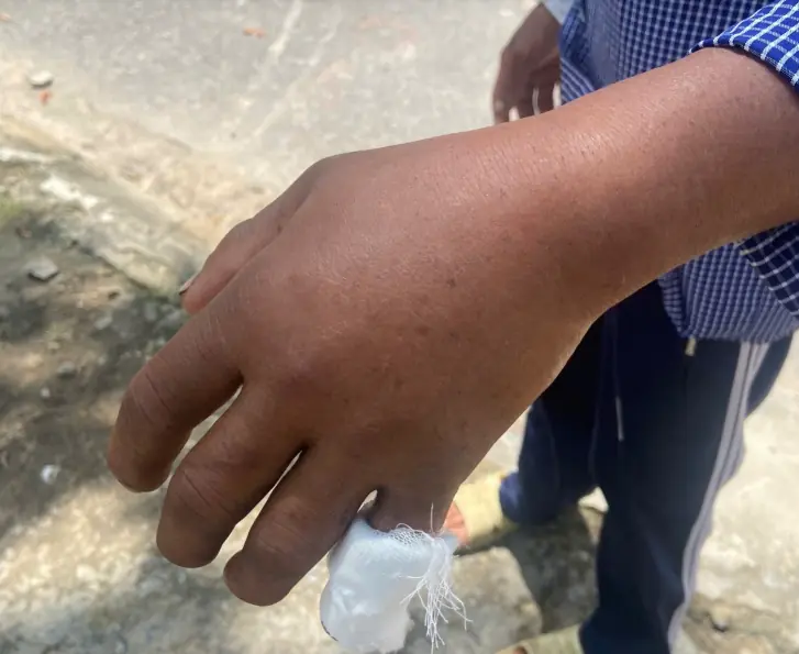 Bị rắn cực độc cắn, người đàn ông cho rắn vào túi bóng, xách cả vào bệnh viện