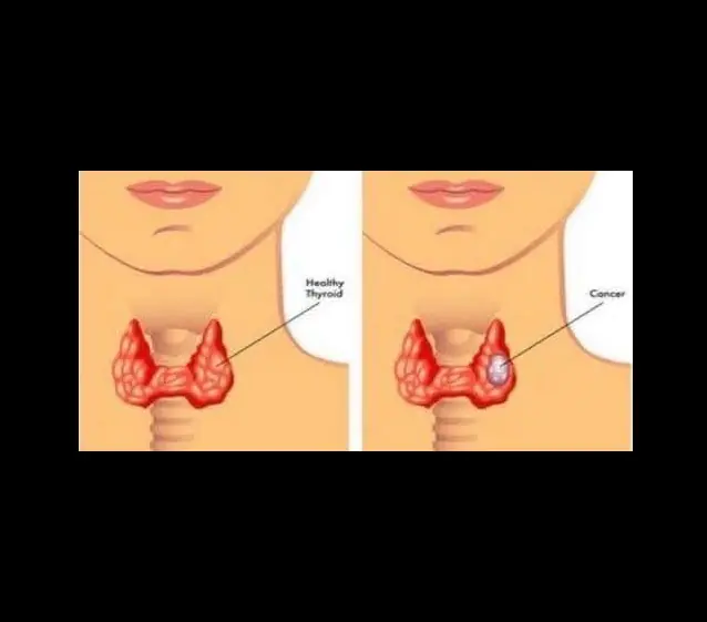 Khi UT vòm họng ban đầu “ghé thăm”, cơ thể có thể phát đi 3 “tín hiệu” đỏ, cố gắng đừng phớt lờ