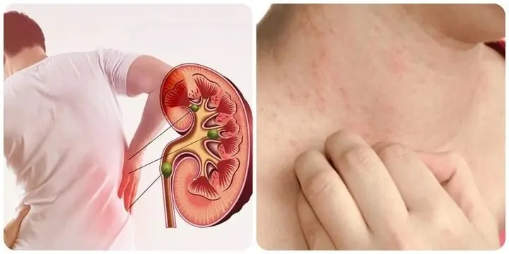 Cơ thể có 7 dấu hiệu này chứng tỏ gan của bạn không khỏe: Điều thứ 2 bệnh đã đi vào giai đoạn nặng