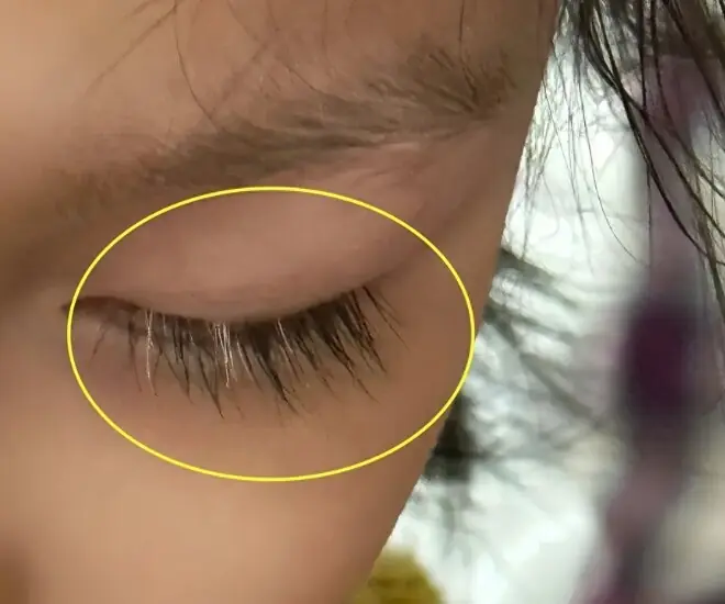 Mẹ phát hiện con gái tiểu học mọc lông mi màu trắng, đưa đến bệnh viện bác sĩ lắc đầu: “Quá muộn!”