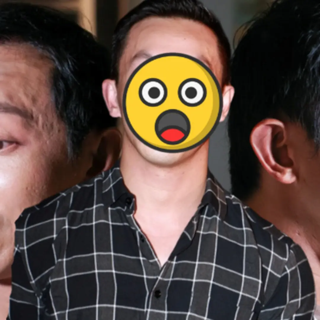 "Hoàng tử showbiz" bị v::ỡ n::á::t gương mặt, phẫu thuật hơn 10 lần để sửa d:u:ng m:ạ:o méo mó biến dạng