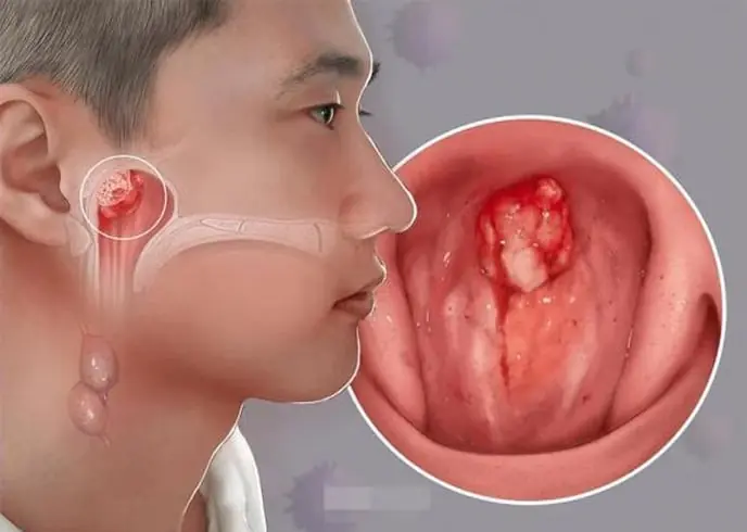 7 dấu hiệu K vòm họng: Số 1 không biết sớm khó mà chữa