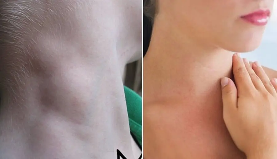 Trên cổ xuất hiện 2 dấu hiệu bất thường này, có thể tế bào K trong cơ thể đã thức tỉnh: Ai cũng cần biết
