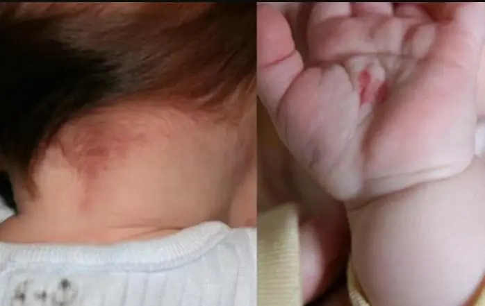 Em bé có bớt đỏ trên người: Dấu hiệu cho thấy con sinh ra với một “vết son” đặc biệt