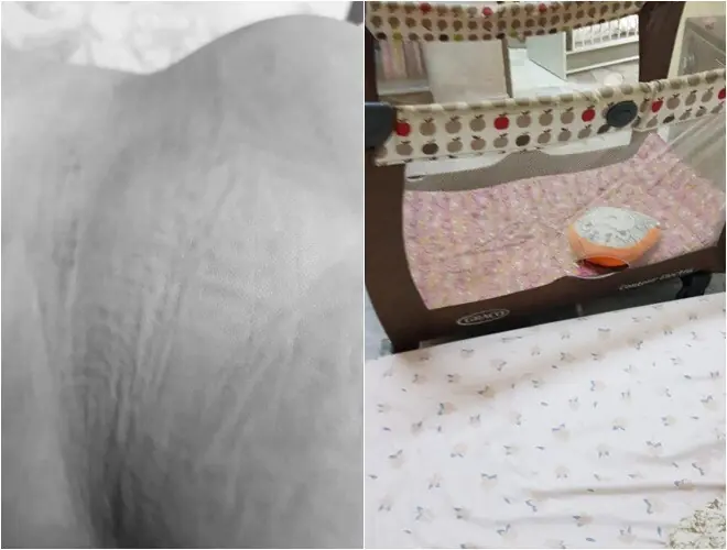 Mẹ âm thầm báo cảnh sát khi thấy vết lạ trên lưng con 14 tháng tuổi, kết quả khám khiến bà rụng rời chân tay