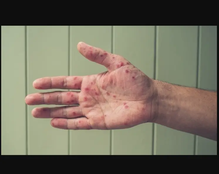 Loại virus đang bùng phát "vượt kiểm soát" ở nhiều quốc gia, Việt Nam ghi nhận tăng hơn 1.000 ca mỗi tuần