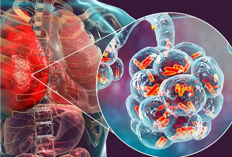 Báo động đỏ: Một loại ung thư 'tăng tốc' không phanh ở Việt Nam - Chuyên gia Bạch Mai cảnh báo khẩn!