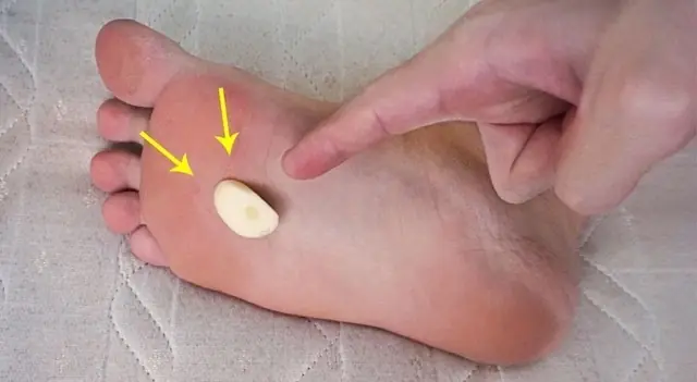 Người phụ nữ 56 tuổi dán tỏi vào lòng bàn chân suốt 6 tháng, kết quả khám sức khỏe khiến bác sĩ "n:gã ng:ửa"