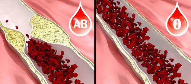 Nếu mang trong người nhóm m:á:u O, bạn nhất định phải biết điều này để giữ lấy m:ạ:ng sống của mình